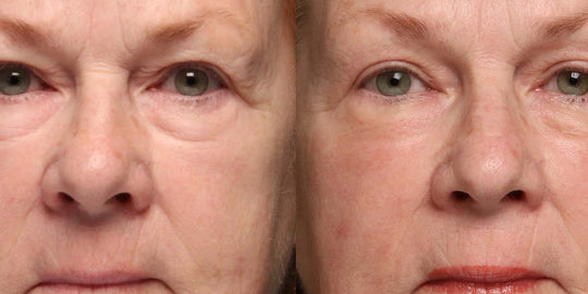 accutite vs liposuction calgary