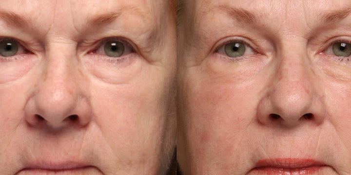 accutite vs liposuction calgary