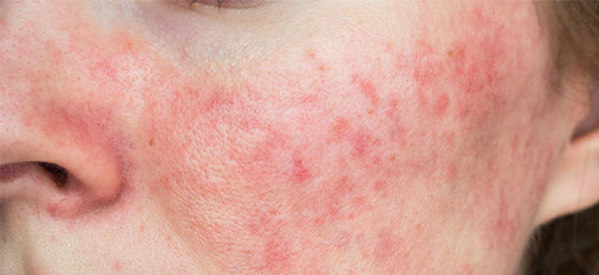 best treatments for rosacea calgary