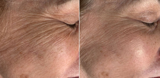 microneedling and PRP before and after results