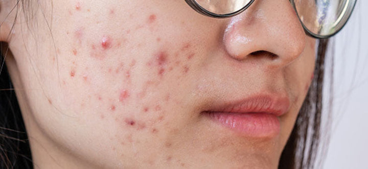 the best facials for acne scars in Calgary