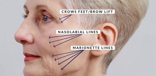 what to expect when getting thread lifts