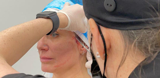 Woman being prepped for a thread lift treatment on the lower face