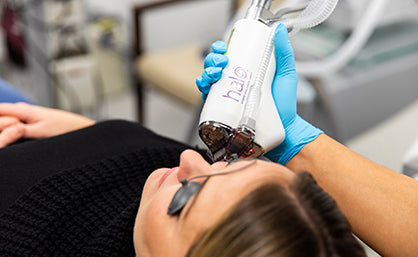 HALO laser skin resurfacing treatment being performed on the face