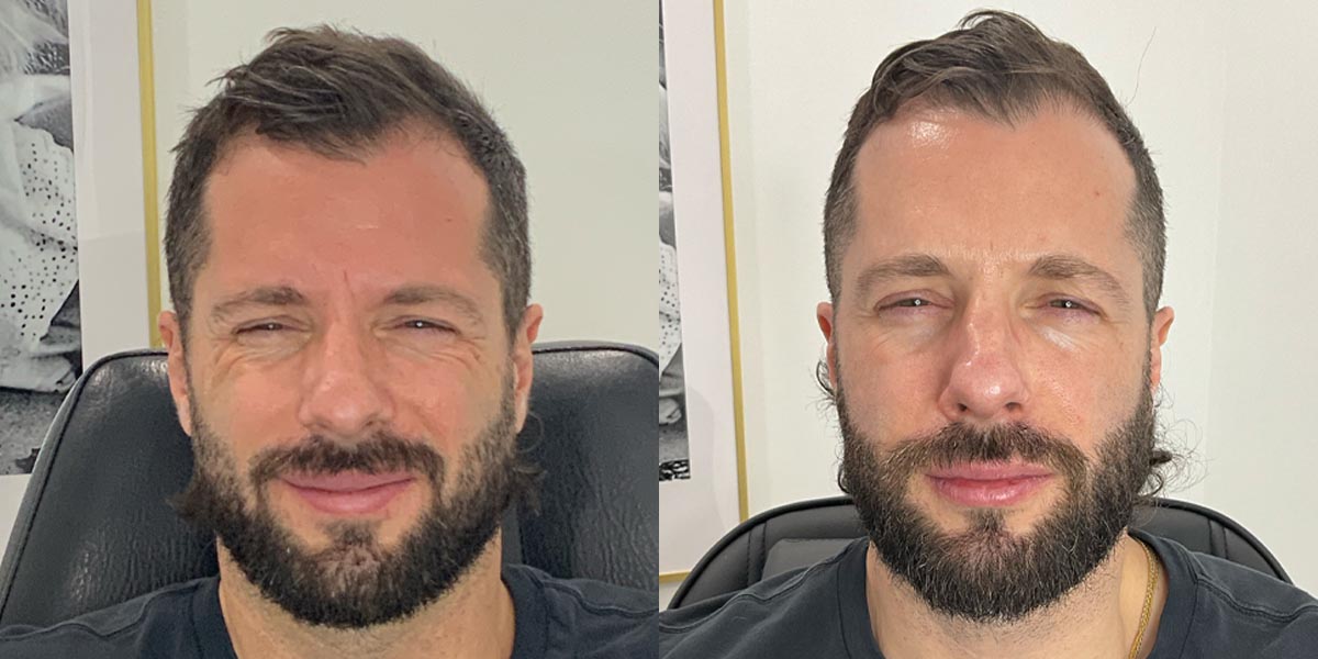Calgary man after Botox injections in Mission at Bardot Beauty.