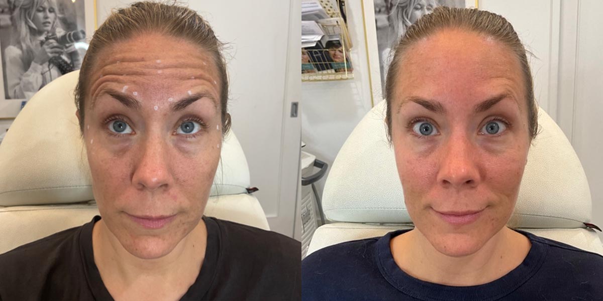 Calgary woman before and after Botox injections at Bardot.
