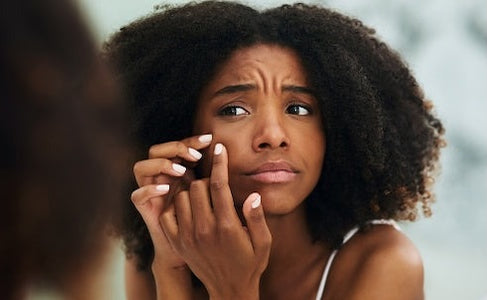 Acne skin program focused on breakouts, congestion, and overall skin clarity