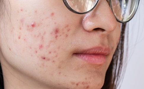 Skin program addressing uneven pigmentation and visible acne scarring